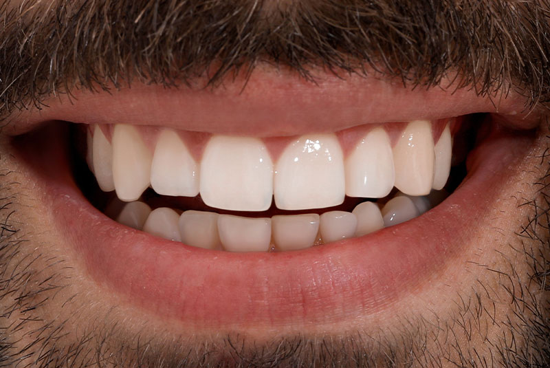 close up of before and after dental procedure