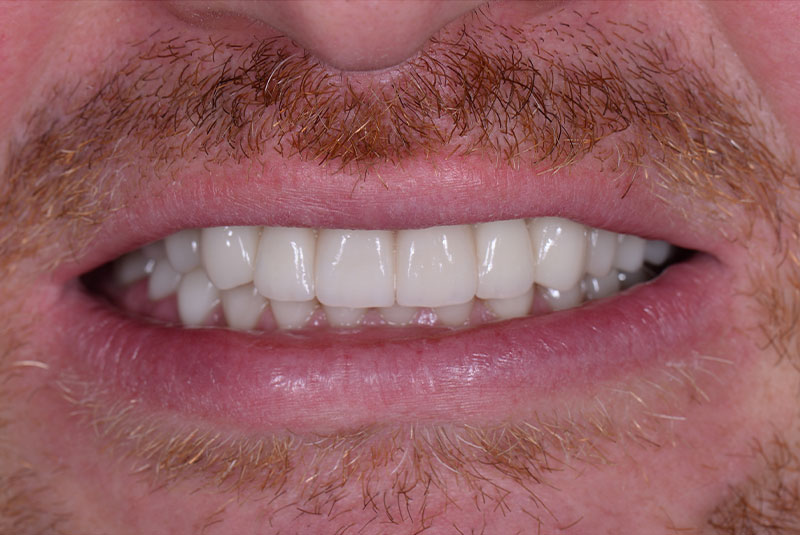 close up of before and after dental procedure