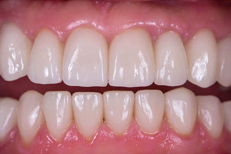 close up of before and after dental procedure