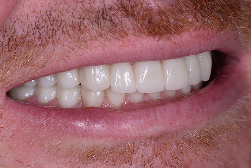 close up of before and after dental procedure