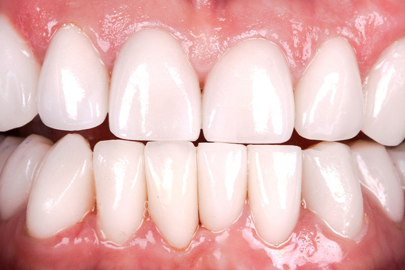 close up of before and after dental procedure