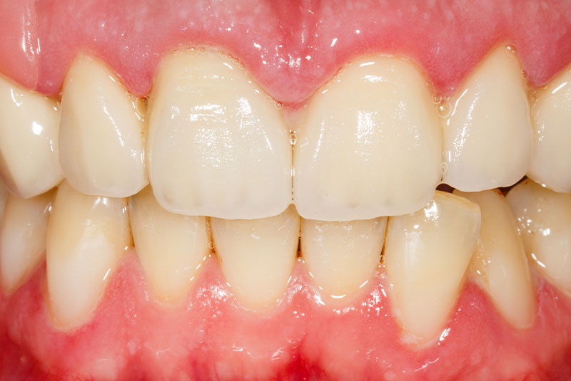 close up of before and after dental procedure