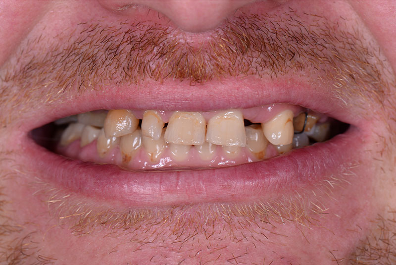 close up of before and after dental procedure