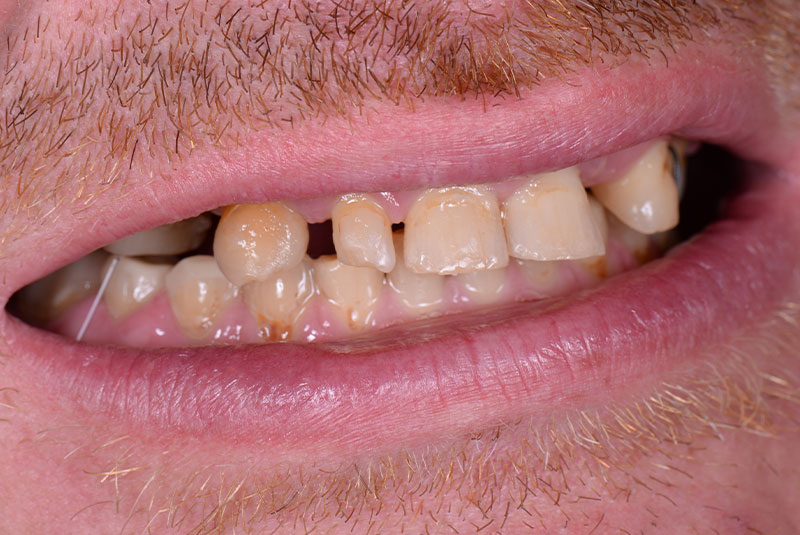 close up of before and after dental procedure