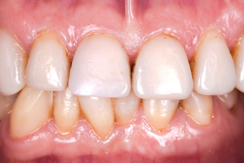 close up of before and after dental procedure
