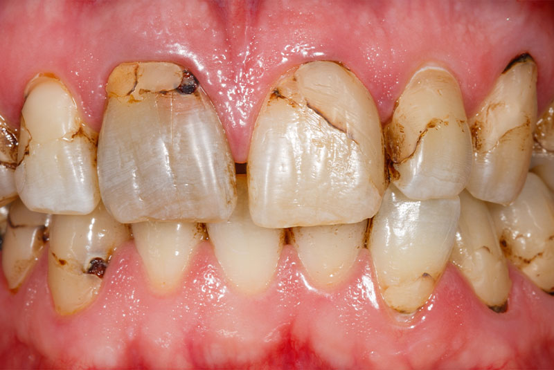 close up of before and after dental procedure