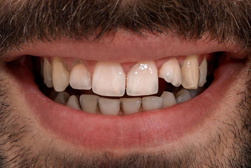 close up of before and after dental procedure