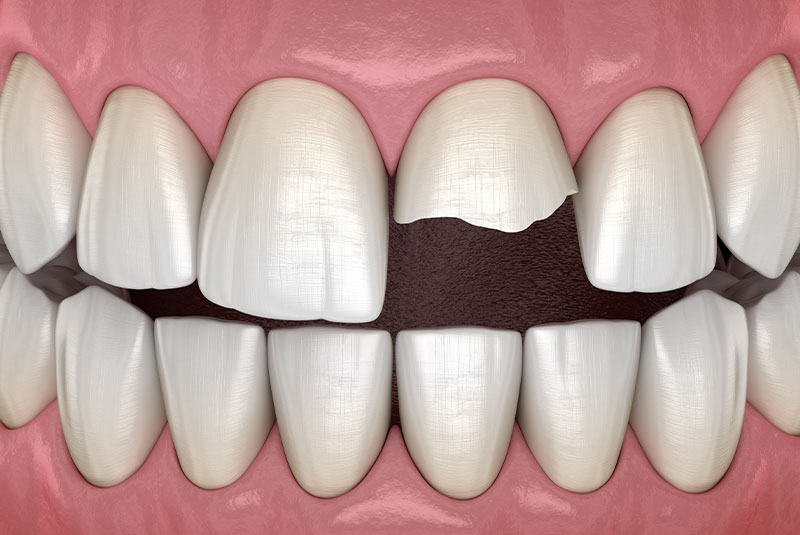 Broken tooth
