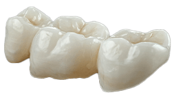 Dental bridge
